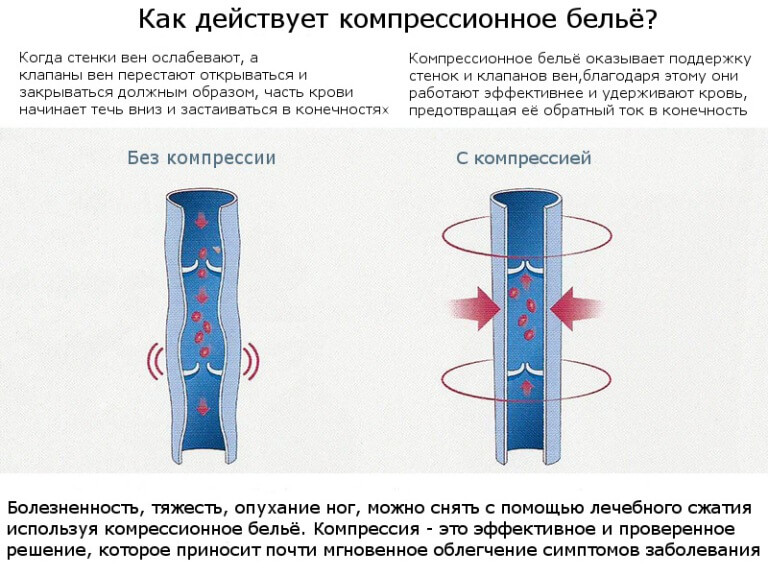 Ретикулярный Варикоз Компрессионное Белье