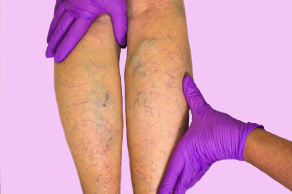Ce injecții să faci cu varice pe picioare Ce injecții din varicoză