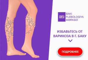 Varicoză pe picioare de femei, Varicele | cvartetbucuresti.ro